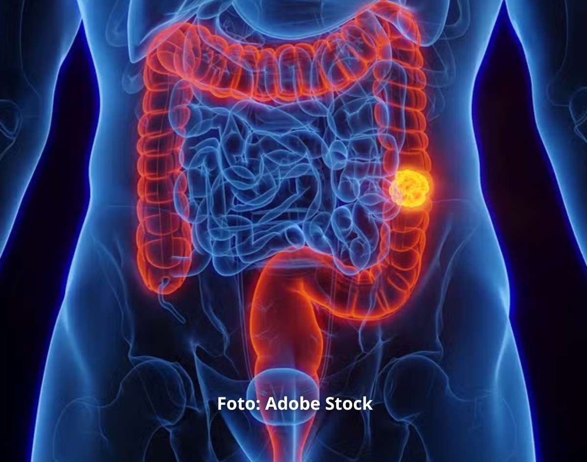 SUS passa a oferecer novo exame para identificar câncer de intestino antes do surgimento dos sintomas 