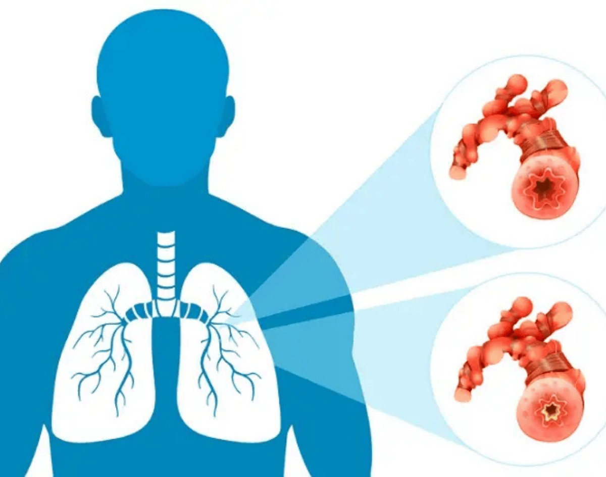 InfoGripe: número de casos de SRAG volta a aumentar em quase todo o país